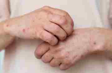 Brasil registra 88 casos de Mpox em 2026; saiba como evitar a doença